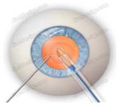 Intraocular Lenses, IOL Intraocular Lens Implant Treatment Delhi Hospital, Lens Implants